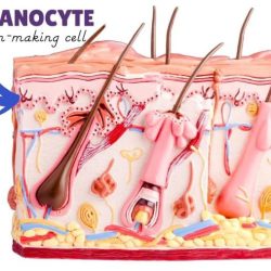 Concentrated melanin cells on the face or body